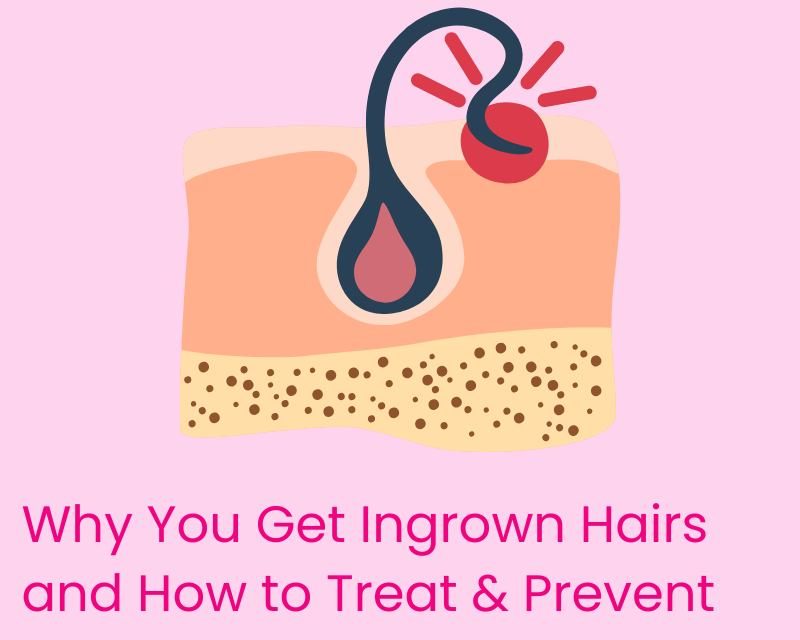 Understanding Ingrown Hairs: Causes, Treatments, and Prevention